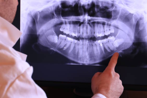 Best Emergency Wisdom Teeth Removal in West Valley City, UT